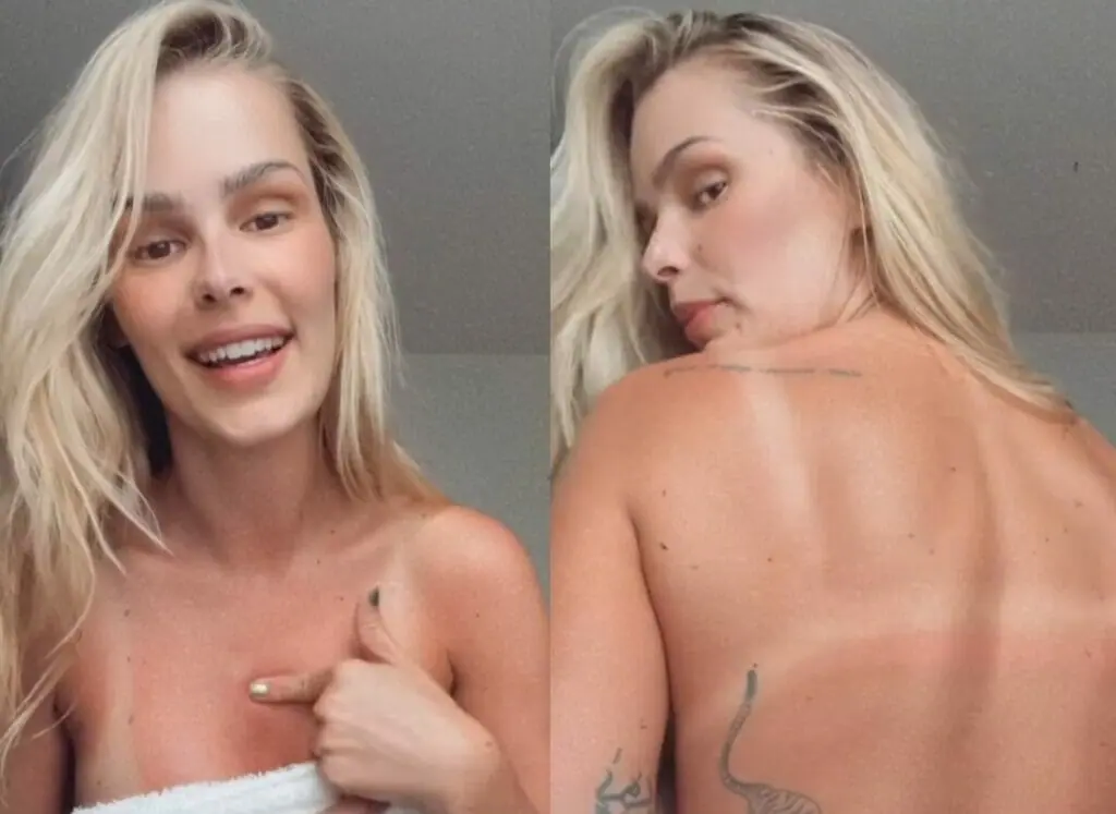 Yasmin Brunet exagera no banho de sol e compartilha o resultado nas redes sociais: “Estou toda vermelha”