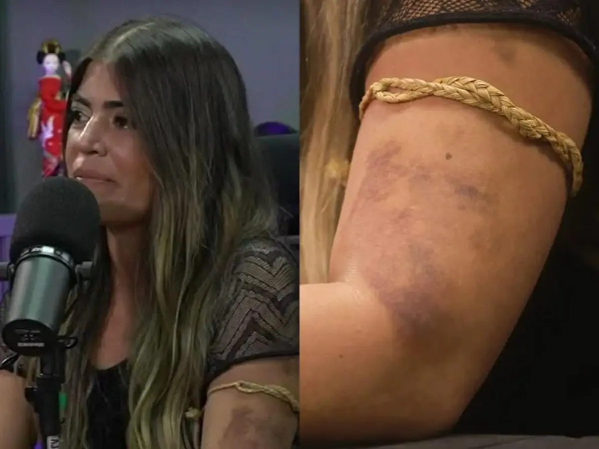 Bruna Surfistinha comove ao mostrar hematomas em podcast