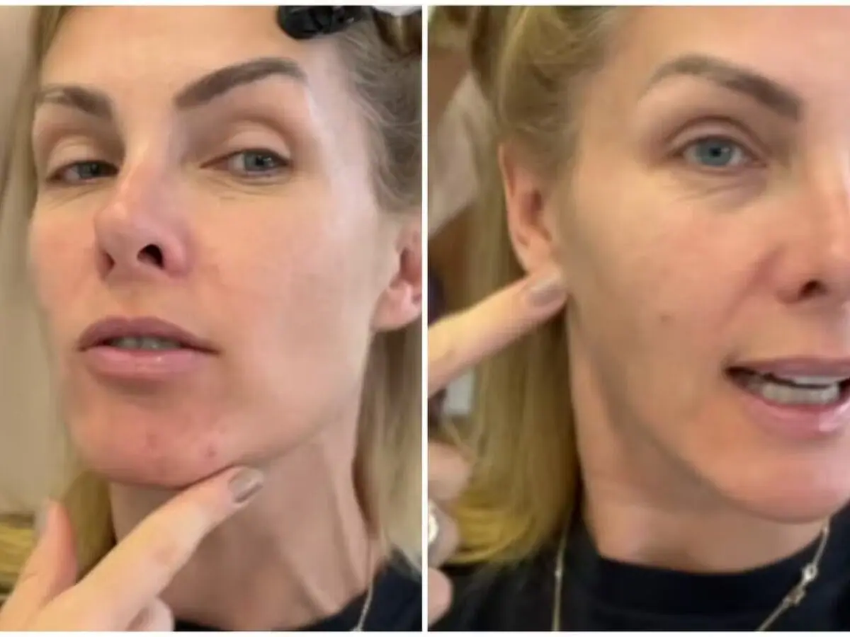 Sem maquiagem, Ana Hickmann mostra espinhas no rosto e brinca: ‘Uma adolescente’